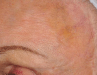 Facial Thread Vein Removal Aberdeen After Image