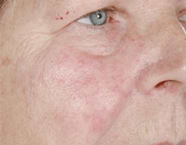 Facial Thread Veins Removal Glasgow After Image