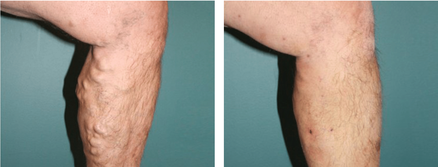 Sclerotherapy Varicose Veins Treatments, Scotland The Vein Surgery
